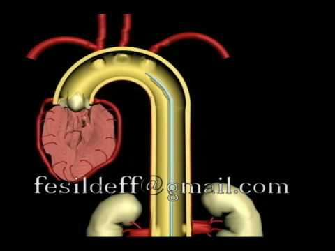Une pompe à ballonnet intra-aortique (IABP)