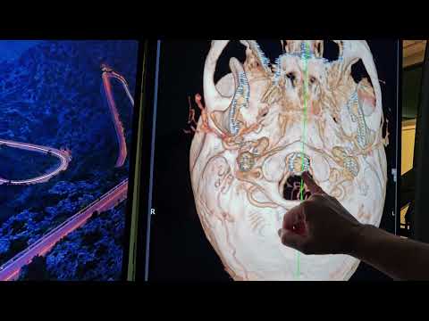 Cervical and Thoracic Syrinx