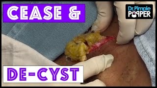 CEASE &amp; DE-CYST!! A Dr Pimple Popper SPECIAL! Part 1