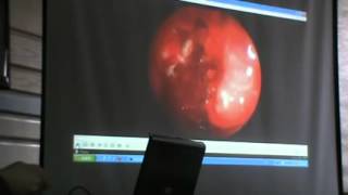 ENT - Dr.Nassem - Nose (4) - Rhinosinusitis - Part 2