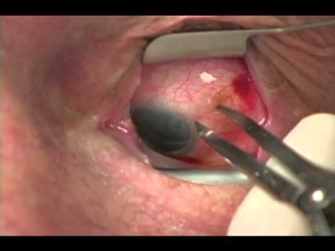 Razumab 10mg Injection