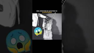 Real depiction of Catatonia in Schizophrenia #psychology