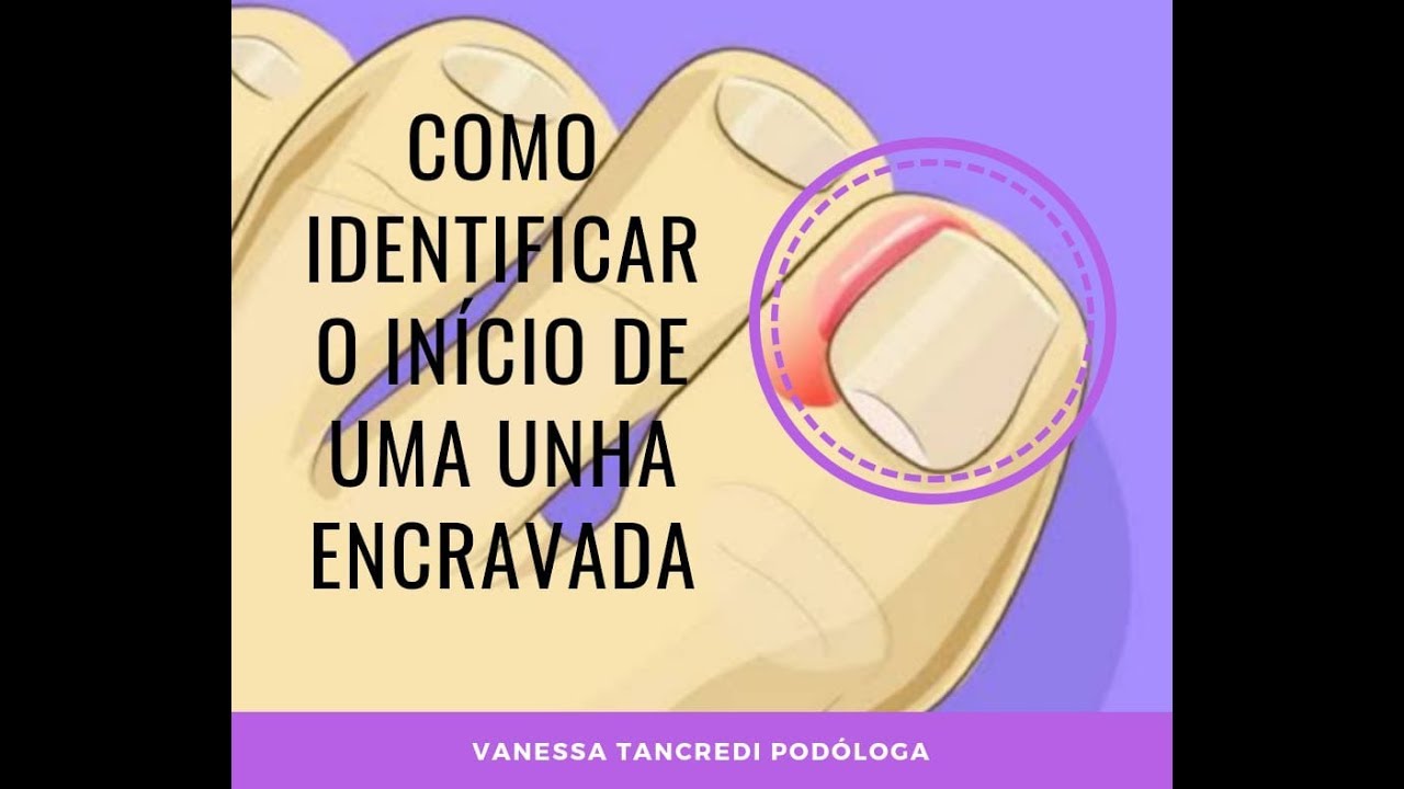 Como Identificar o início de uma Unha Encravada