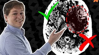 COMO VER AVC NA TOMOGRAFIA DE CRÂNIO? AVCI AGUDO X CRÔNICO | AULA DE TC #11