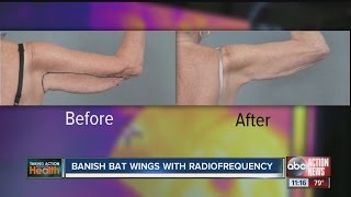 New treatment targets flabby arm fat