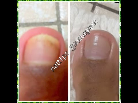 Antibiotic na may fungi sa kuko Murang unguento sa mga halamang-singaw sa balat