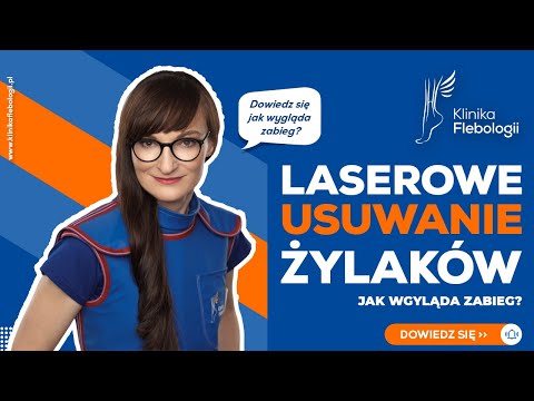 Laserowe usuwanie żylaków - jak wygląda zabieg?