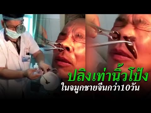 ขี้ผึ้งสำหรับโรคสะเก็ดเงิน ที่ได้รับจากคันของโรคสะเก็ดเงิน