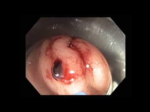 APC of Bleeding Telangiectasia after Radiotherapy