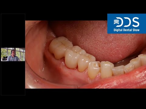 The full spectrum of the Zolid DNA Generation | #DigitalDentalShow Lecture Recording