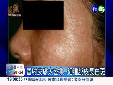 愛美打雷射長白斑 竟是皮膚癌