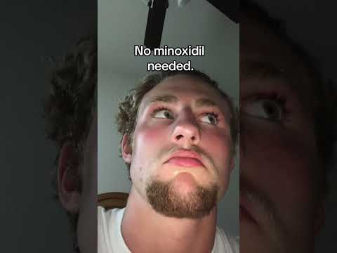 Did I use Minoxidil to grow my Beard?