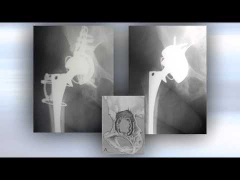 Trabecular Metal Implant Experience