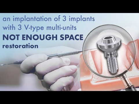 An implantation of three implants when NOT ENOUGH SPACE for dental restoration