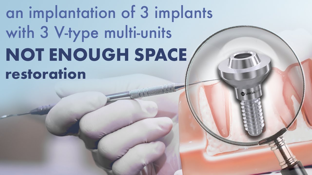 An implantation of three implants when NOT ENOUGH SPACE for dental restoration