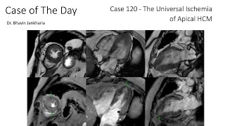 Case of the Day - 120 - 2025 10 16 - The Universal Ischemia of Apical HCM