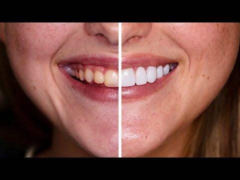 Composite vs Porcelain Veneers (San Antonio Dentist Reveals Winner)