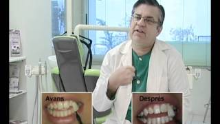 Tratamientos de blanqueamiento dental en la Clínica Dental del Dr. Amadeo en Gandía