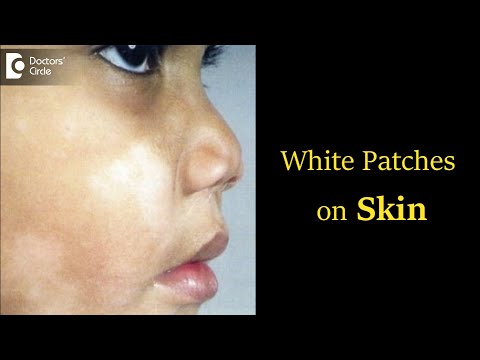 White Patches on Skin: What can it be? Diagnosis, Causes, Symptoms -Dr. Rasya Dixit| Doctors' Circle