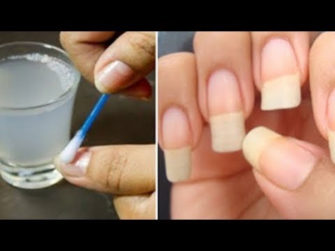 Der Nagelzwang die Behandlung in donezke Wie die Nagelkrankheiten zu heilen