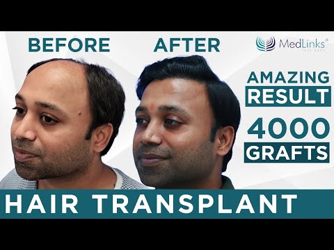 hair transplant in india
