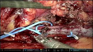 Core Videos (2024): Radical Nephrectomy with Low-Level Inferior Vena Cava Tumor Thrombectomy