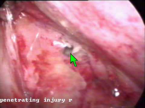 Laparoscopic management of penetrating rectal injury