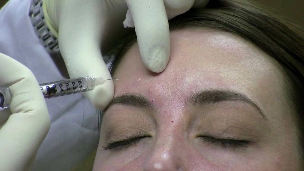 Botox Injection Technique for Wrinkle Reduction in Virginia