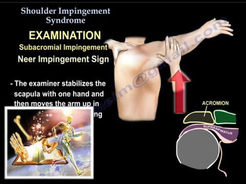 Shoulder Impingement Syndrome  - Everything You Need To Know - Dr. Nabil Ebraheim