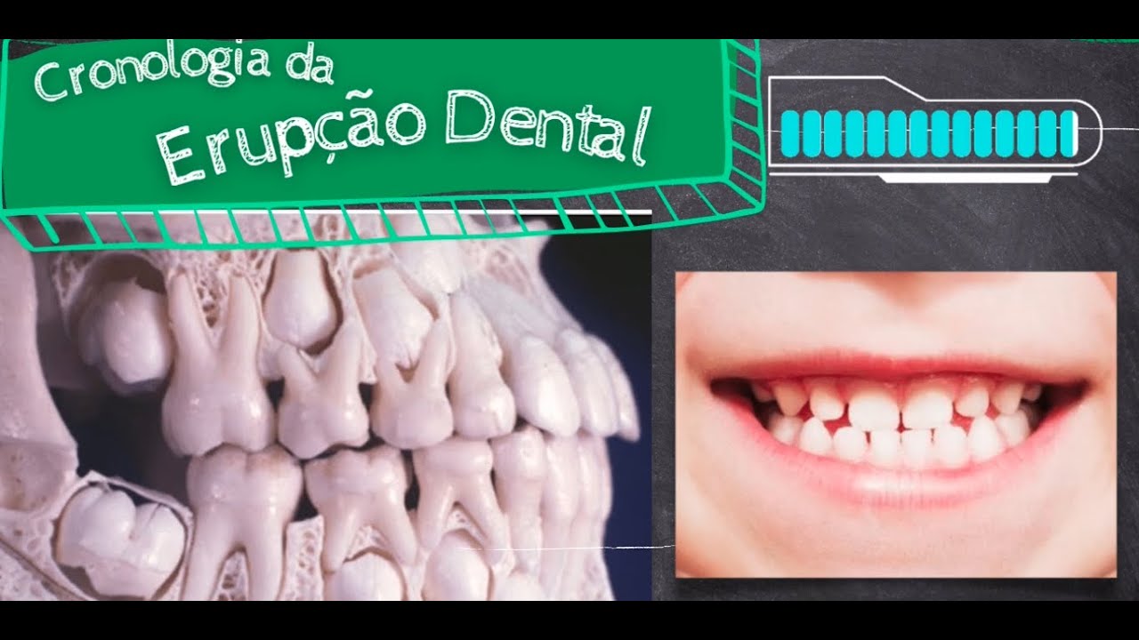 Cronologia de Erupção dos Dentes (Decíduos/Leite e Permanentes)