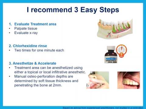 Dental Treatment: Accelerated Orthodontics Apr 18, 2017