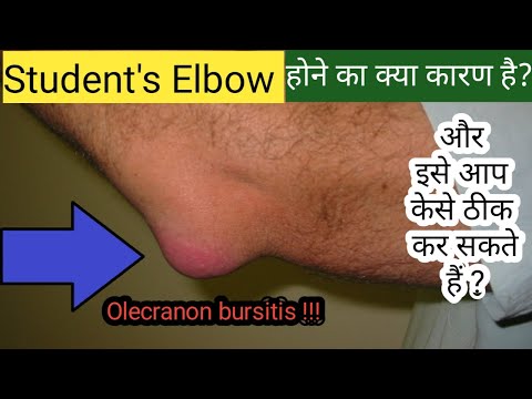 Olecranon Bursitis (Elbow Bursitis) | Student's Elbow | Prevention, Treatment, Exercises & Home Care