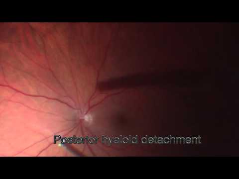 Optic Disc Pit Maculopathy