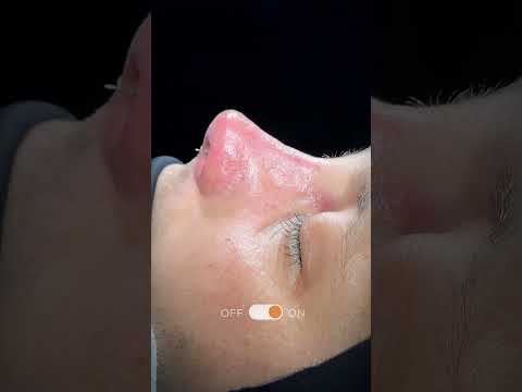 Bursa Burun Estetiği - Male Rhinoplasty - Dr Özlem Oymak