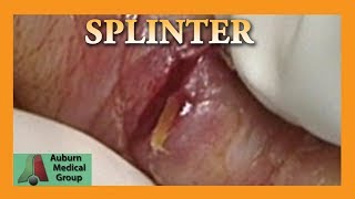 Dr. Gawayne Removes a Foreign Body from a Patient's Hand | Auburn Medical Group