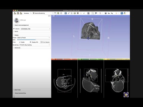 Cropping a Volume   [3D Slicer Workflow]