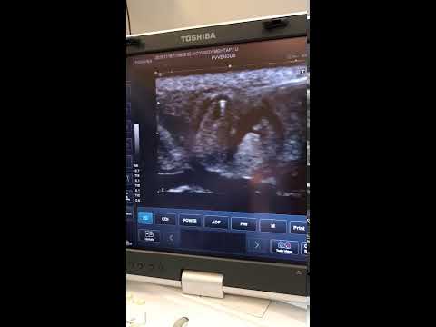 Endovenöz Lazer Tedavisi (Evla)