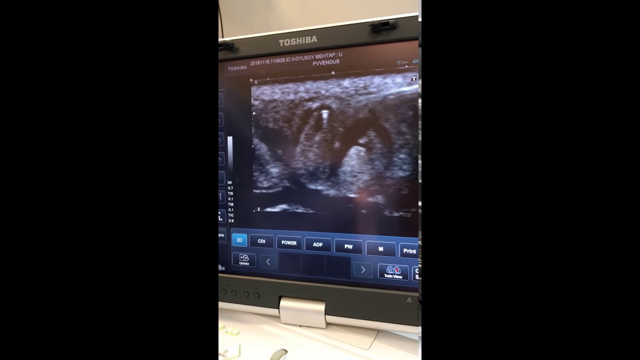 Endovenöz Lazer Tedavisi (Evla)