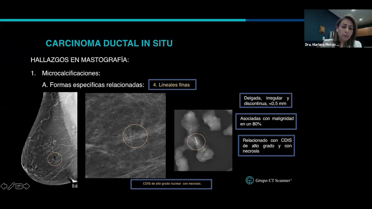 Carcinoma ductal in situ