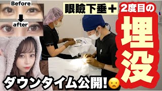 【二重整形】ダウンタイムほぼなし！！?✨2回目の二重埋没?＋切らない眼瞼下垂?ダウンタイムの様子・クリニック?紹介etc..^._.^❤︎！！【目の大きさに悩んでる人見て欲しい?】