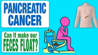 Pancreatic Cancer - Can it Make our Feces Float?