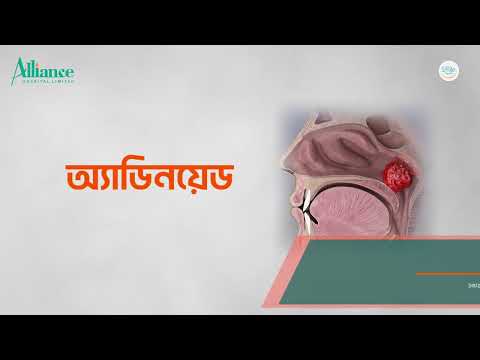এডিনয়েড কি এবং এর কারণ, লক্ষণ, জটিলতা ও চিকিৎসা | ডাঃ মোঃ সুমন হোসেন