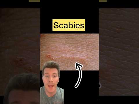 Doctor explains SCABIES in 60 seconds - causes, symptoms, treatment #shorts #scabies #health