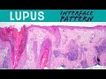Lupus Erythematosus - Interface Dermatitis: Inflammatory Dermpath Basics for Dermatology & Pathology