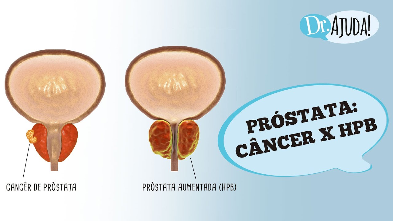 5 PRINCIPAIS DIFERENÇAS CÂNCER DE PRÓSTATA E CRESCIMENTO BENIGNO DA PRÓSTATA