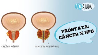 5 PRINCIPAIS DIFERENÇAS CÂNCER DE PRÓSTATA E CRESCIMENTO BENIGNO DA PRÓSTATA