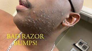 The only CURE that gets rid of RAZOR BUMPS- B&C ROLL ON