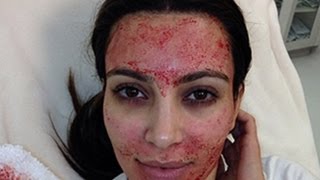 Kim Kardashian Bathes in Human Blood : Vampire Facelift ! Plus Singing Bus Driver!