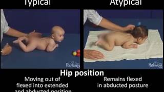 So sánh trẻ bình thường và bất thường: 2 tháng tuổi