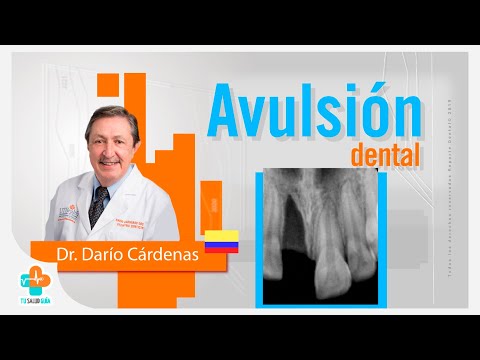 Avulsión Dental | Tu Salud Guía